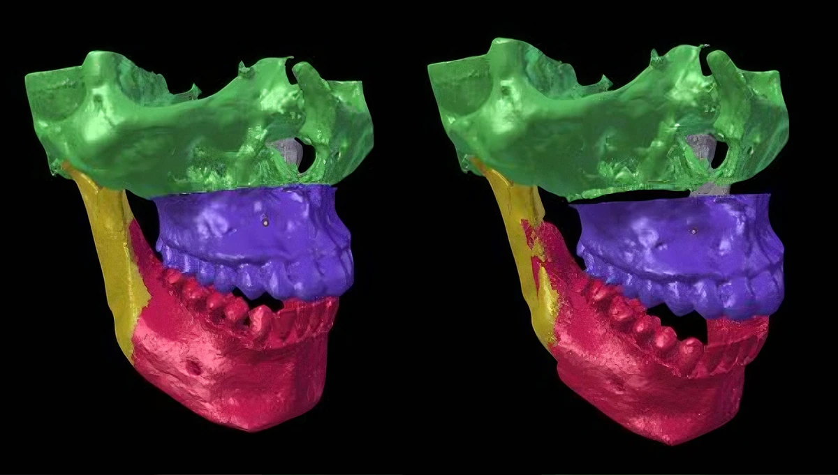 Color segmentation view of digital jaw model for 3D printing with NextShapes Dental Model Resin, demonstrating digital treatment planning integration