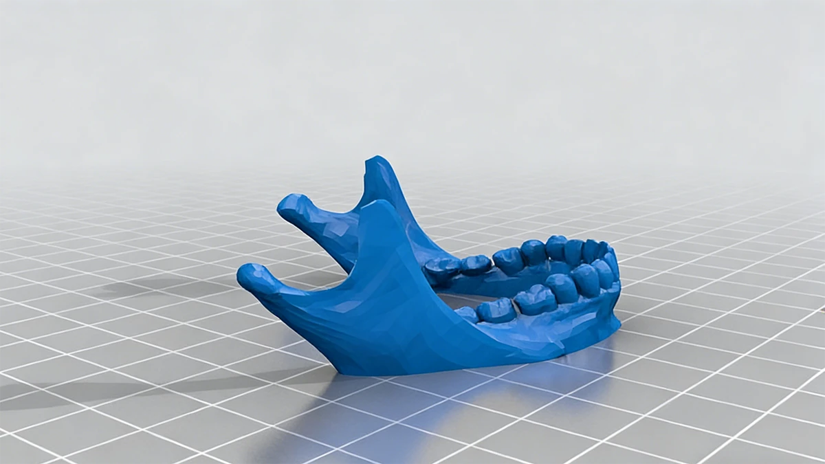 Display of 3D printed blue orthodontic aligner model made with NextShapes Dental Model Resin, highlighting clear aligner treatment planning support